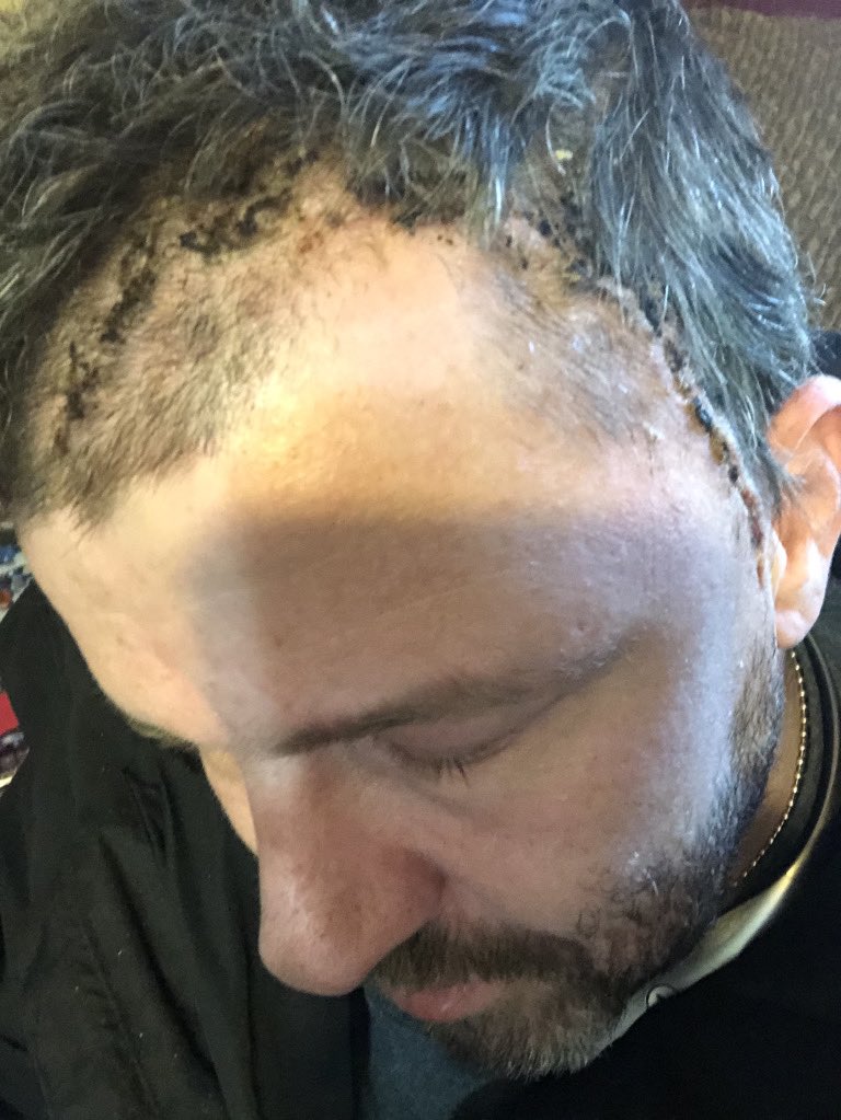 Str8EdgeMike69's tweet photo. @MegsOnTwitch Here’s the after surgery pics https://t.co/LPJNC00jfT