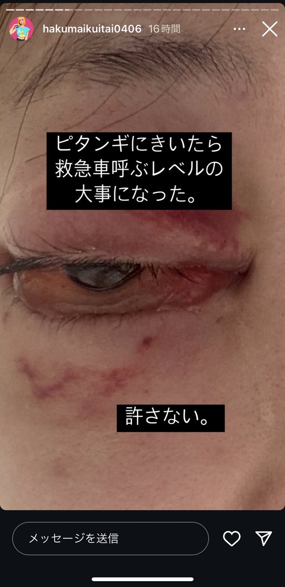 VinegaredKelp's tweet photo. 最近話題になり始めた奥目脂肪移植、続々と被害者が……🥶🥶🥶

失明、脳に菌が回るなど最悪シャレにならない手術

SNSの扇動に流されず自分を大切にしてください
健康が一番の美だよ🥲 https://t.co/efk5PX3jx9