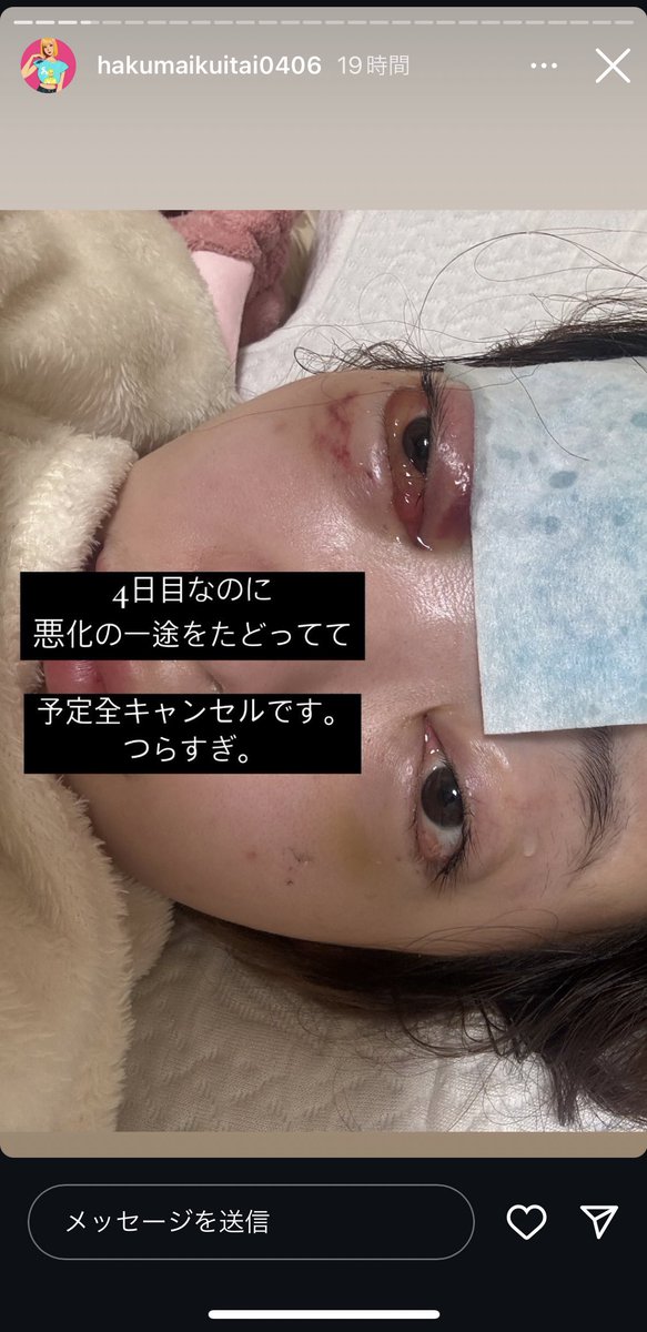 VinegaredKelp's tweet photo. 最近話題になり始めた奥目脂肪移植、続々と被害者が……🥶🥶🥶

失明、脳に菌が回るなど最悪シャレにならない手術

SNSの扇動に流されず自分を大切にしてください
健康が一番の美だよ🥲 https://t.co/efk5PX3jx9