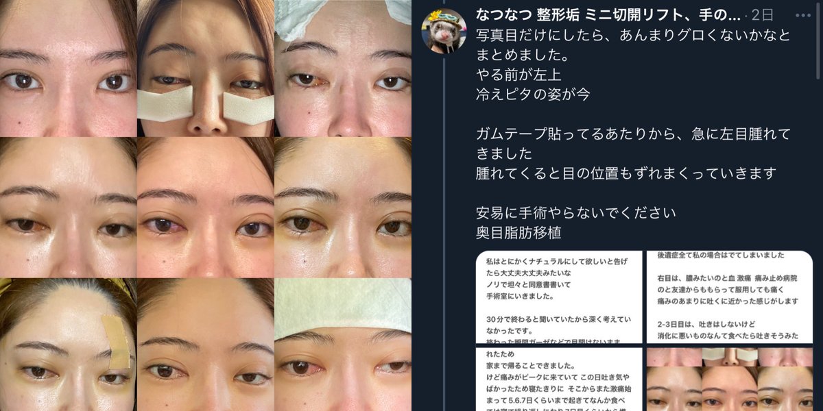 VinegaredKelp's tweet photo. 最近話題になり始めた奥目脂肪移植、続々と被害者が……🥶🥶🥶

失明、脳に菌が回るなど最悪シャレにならない手術

SNSの扇動に流されず自分を大切にしてください
健康が一番の美だよ🥲 https://t.co/efk5PX3jx9