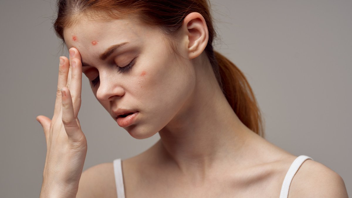 nikkiyeltonrd's tweet image. The important piece to acne we're missing is why is the body producing too much sebum to begin with, overloaded with C. acnes bacteria, and in a persistent inflammatory state. #gettotheroot #functionalmedicine