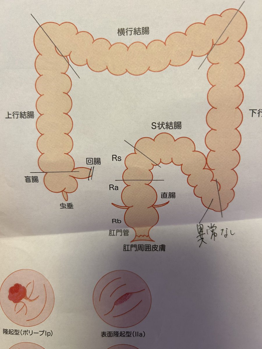 無事に大腸内視鏡検査終わり、異常なしでした👌
鎮静剤使ってもらったので即寝したと思ってたら処置中受け答えしてたらしくて怖い。記憶がない。 