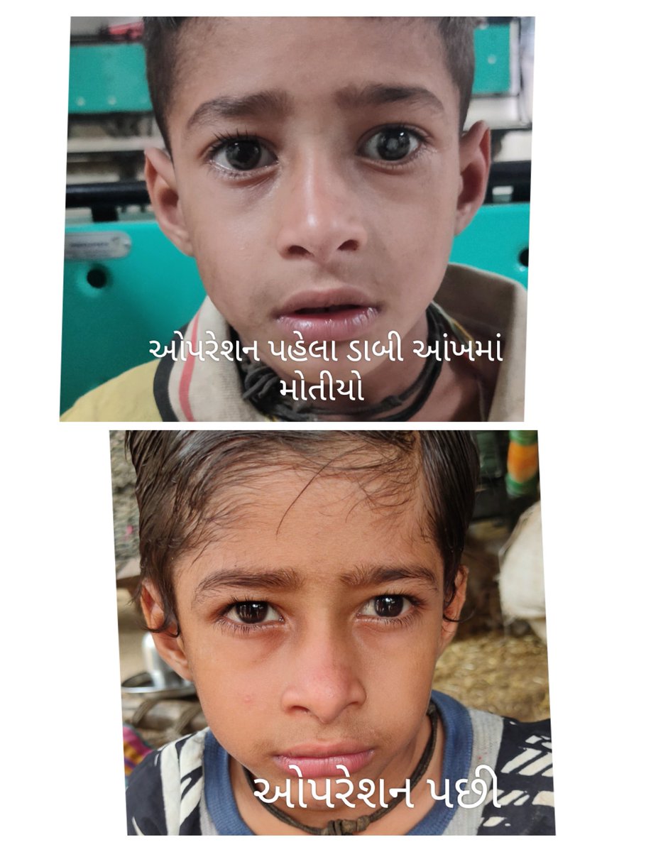 ગરબાડા માં RBSK Program અંતર્ગત ત્રાંસી આંખ તથા જન્મજાત મોતીયોની ખામી ધરાવતા બે બાળકોના ઓપરેશન કરાવામાં આવ્યા. More happiness after Operation of Visible Birth Defect <a href="/GujaratRbsk/">RBSK GUJARAT🇮🇳🇮🇳🇮🇳</a> <a href="/HealthDahod/">Health Dahod</a> <a href="/CollectorDahod/">Collector Dahod</a> <a href="/DahodDdo/">DDO Dahod</a> <a href="/MoHFW_INDIA/">Ministry of Health</a> <a href="/TDO_Garbada/">TDO GARBADA</a> <a href="/chonodalgarbada/">CHO -TEAM GARBADA 👩‍⚕️🩺</a> <a href="/our_garbada0446/">our_garbada0446</a>