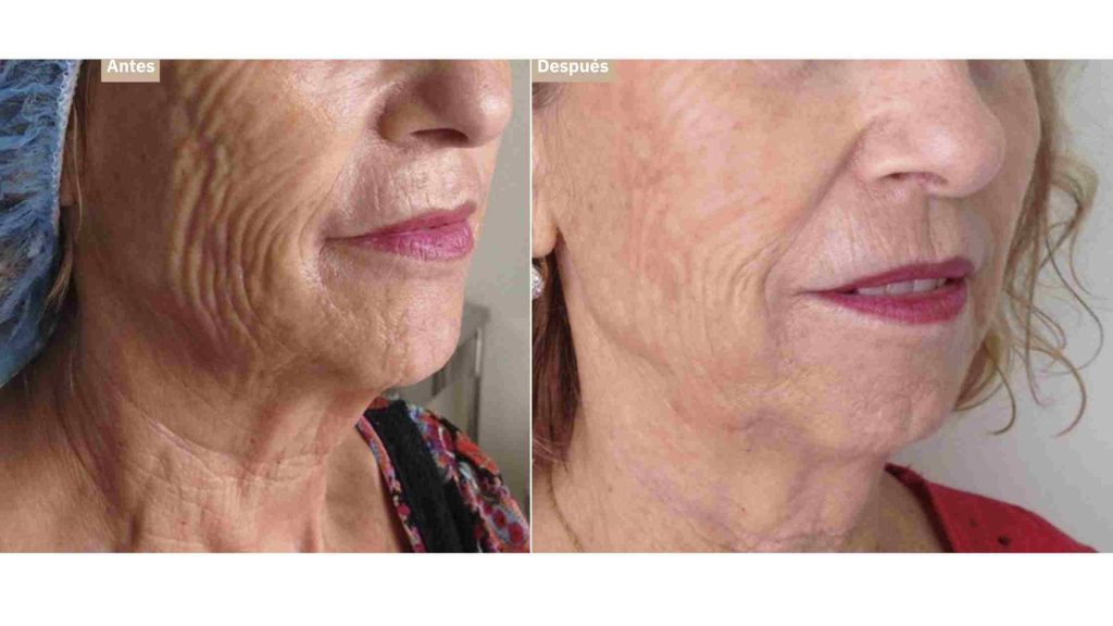 🔵#Artículo | Los rellenos dérmicos clasificados como inductores de colágeno son una tendencia creciente en #Medicina estética. En este artículo, la Dra. Victoria Páez repasa su experiencia personal con el #PLLA, el #PCL y #HACa. 

🔗Artículo completo: expertosenmedicinaestetica.es/mi-experiencia…