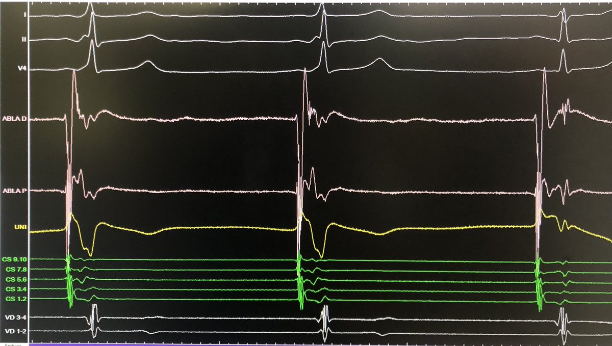 Eduardo Franco Díez (@edufrancodiez) on Twitter photo One can always learn something even from “simple” cases: accessory pathway potential delay mechanically induced by the ablation catheter 🤩. No more mapping needed 😅 ! Note the preexcitation pseudo-disappearance due to the AP delay.
<a href="/Arritmias_HRC/">Arritmias H. Ramón y Cajal, Madrid.</a> One can always learn something even from “simple” cases: accessory pathway potential delay mechanically induced by the ablation catheter 🤩. No more mapping needed 😅 ! Note the preexcitation pseudo-disappearance due to the AP delay.
<a href="/Arritmias_HRC/">Arritmias H. Ramón y Cajal, Madrid.</a>