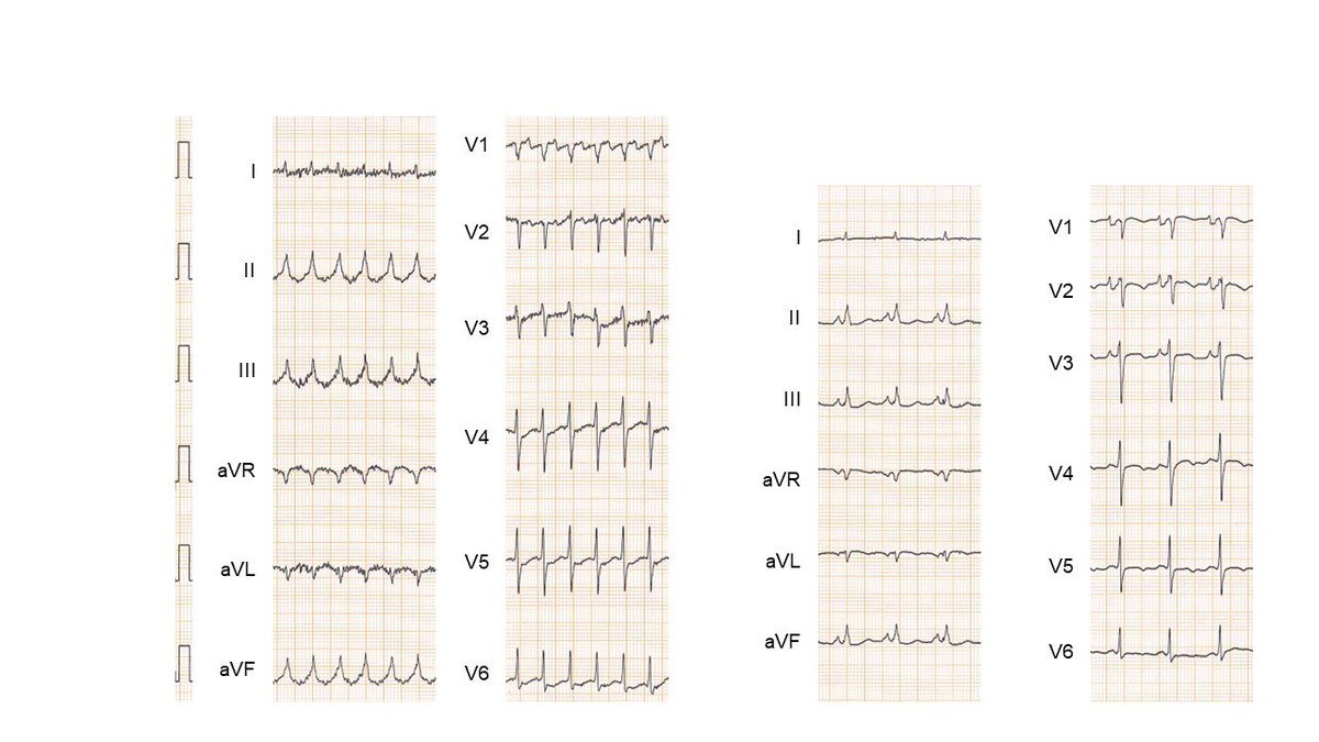 Level: 🌶️🌶️🌶️ of 5
Q1: What's the potential diagnosis?

Please hold off for 3 hours on answering if you watched my ex-post...sorry😅

#EPUniversity
#EPeeps