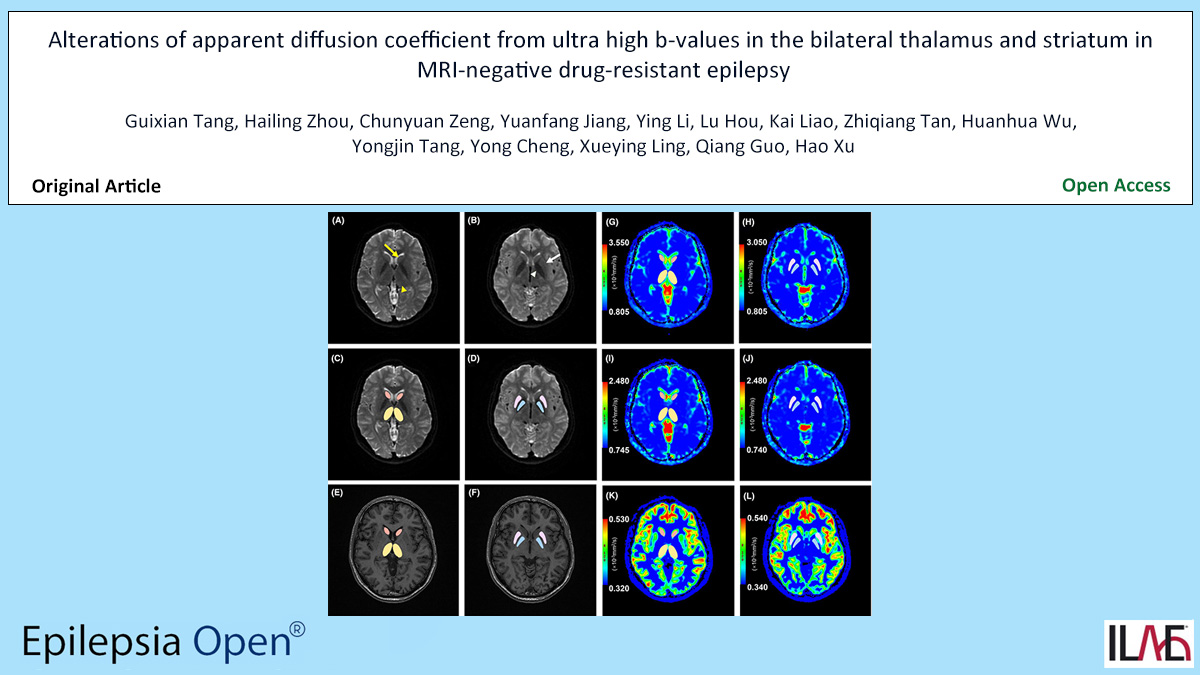 EpilepsiaOpen's tweet photo. Key point: #Diffusion-weighted imaging (DWI) with ultra high b-values may be valuable for the detection of membrane water permeability alterations.
https://t.co/KefbzZPLrr
#epilepsy #ILAE #MRIe #drugresistantepilepsy #striatum #thalamus @IlaeWeb @epilepsiaopen @WileyNeuro https://t.co/oLKGeGZLz7