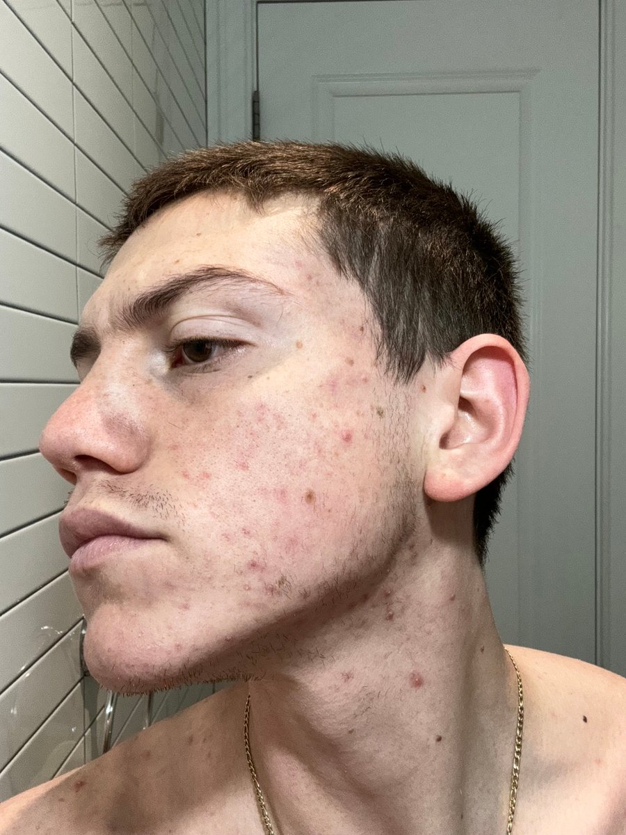 AcneHub's tweet image. June 29, 2024
Wash: WW, Pineapple
3 boiled eggs
Ginger
Double Espresso, Milk Thistle, Cinnamon
Sardines, Red Kidney Beans, Evoo
Wash: WW, TT