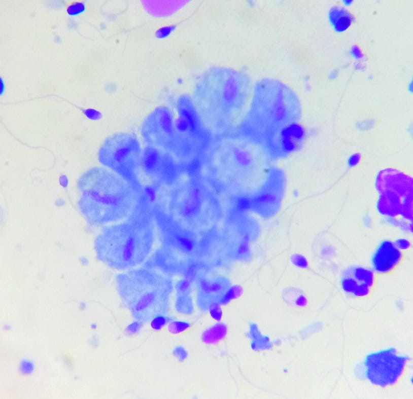 Lisa Andrology Lab Petr贸polis, RJ, Brazil馃嚙馃嚪 (@lisaandrollab) on Twitter photo <a href="/Lisaandrollab/">Lisa Andrology Lab Petr贸polis, RJ, Brazil馃嚙馃嚪</a> images from Advanced Semen Analysis.
A beautiful, interesting and rare image of an aggregation of Trichomonas sp in semen analysis. <a href="/Lisaandrollab/">Lisa Andrology Lab Petr贸polis, RJ, Brazil馃嚙馃嚪</a> images from Advanced Semen Analysis.
A beautiful, interesting and rare image of an aggregation of Trichomonas sp in semen analysis.