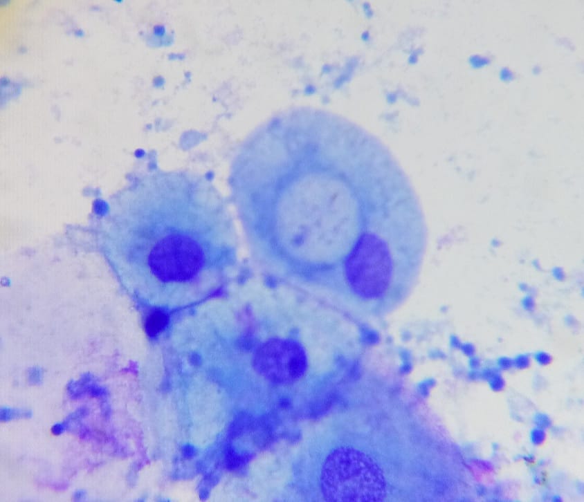 Lisa Andrology Lab Petr贸polis, RJ, Brazil馃嚙馃嚪 (@lisaandrollab) on Twitter photo <a href="/Lisaandrollab/">Lisa Andrology Lab Petr贸polis, RJ, Brazil馃嚙馃嚪</a> images from Advanced Semen Analysis.
A cellular inclusion of Chlamydia trachomatis in an azoospermic patient. Chlamydia can cause obstructive azoospermia. <a href="/Lisaandrollab/">Lisa Andrology Lab Petr贸polis, RJ, Brazil馃嚙馃嚪</a> images from Advanced Semen Analysis.
A cellular inclusion of Chlamydia trachomatis in an azoospermic patient. Chlamydia can cause obstructive azoospermia.