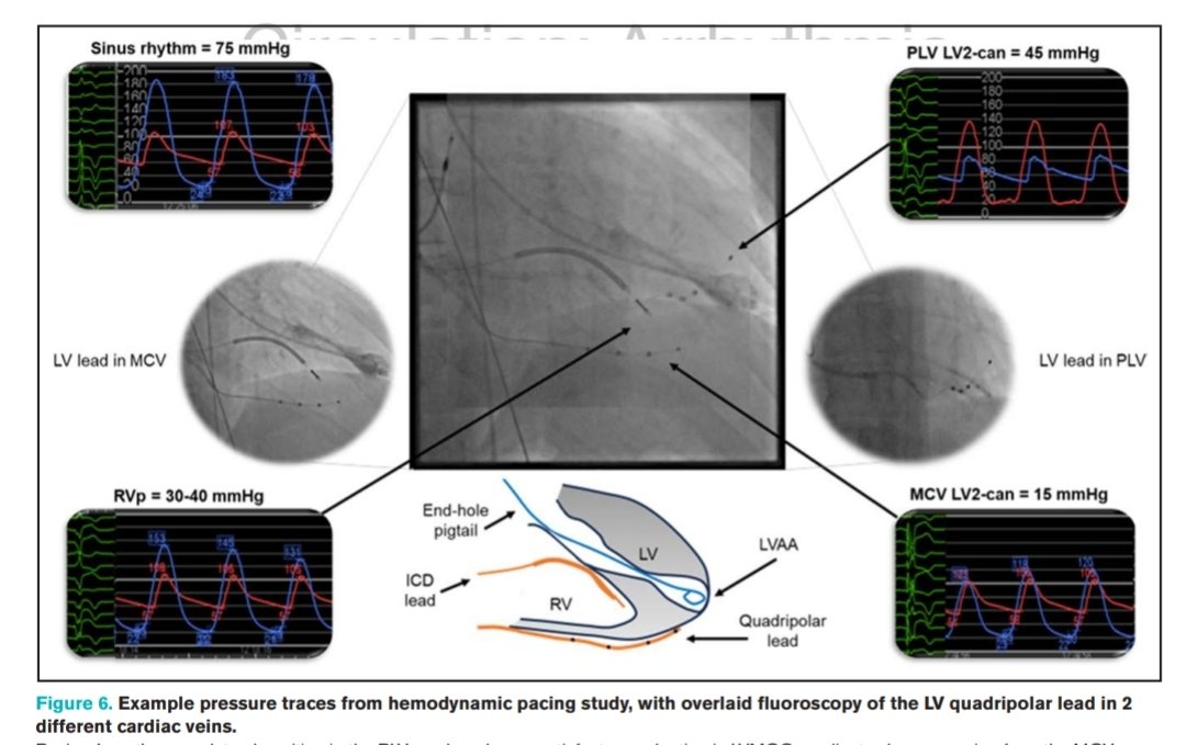 🧐Abordaje original y novedoso para los pacientes con miocardiopatía hipertrófica que presentan obstrucción intraventricular refractaria a 💊 

<a href="/Cardio_H12O/">Servicio Cardiología H12O</a> <a href="/Arritmias12Oct/">Unidad de Arritmias Hospital 12 de Octubre</a>
 <a href="/ritmo_SEC/">Asociación del Ritmo Cardiaco</a>

Comentario en <a href="/blogarritmias/">Blog Arritmias ARC</a>
👇🏻🤓👇🏻