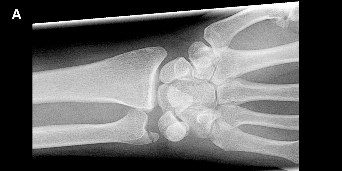 AAOS1's tweet photo. Think you know #wrist injuries? Put your knowledge to the test! Identify the #lunate dislocation in this set.
Explore challenges like this across #orthopedic topics and master diagnostic techniques in the #DxSpotlight course https://t.co/J1PHWFKjXM
#LearnwithAAOS
#orthotwitter https://t.co/QoZpxUUvcr