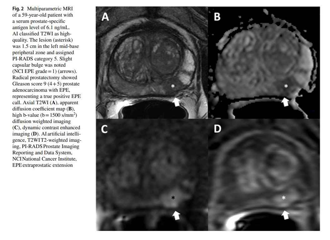 radiolobt's tweet photo. 📣I am happy to share our new publication "Deep learning-based image quality assessment: impact on detection accuracy of prostate cancer extraprostatic extension on MRI" https://t.co/x9FA12Sqbu
👍Congratulations to @yuexlin @BelueMason @eniscy @lawyanmee @davidgelikman @BradWoodMD @SandeepGurramMD @PeterPintoMD @PChoyke and our Team members for this nice work
#prostatecancer #prostateMRI #CancerResearch #TeamScience