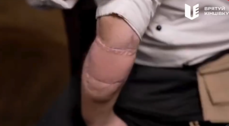 2HOUP_org's tweet photo. On Oct 10, 2022, Kyiv waiter Valeriy Chaika was severely injured by shrapnel from a Russian missile. Despite facing potential amputation, doctors from the #SaveTheLimb program performed 7 surgeries to save his arm. Valeriy now has a chance to return to his beloved job. 🙏🇺🇦 https://t.co/YQlQh2k4lZ