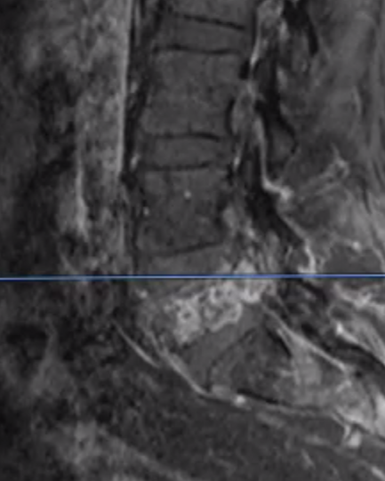ChakravarthyMD's tweet photo. What factors influence your decision-making to involve Minimally Invasive Techniques in Spine Oncology?
❓How would you approach this #SpineOncology Case?
Details are in the thread below.
#spine #neurosurgery #MultipleMyeloma #PathologicFracture https://t.co/GjzOGr6ePI