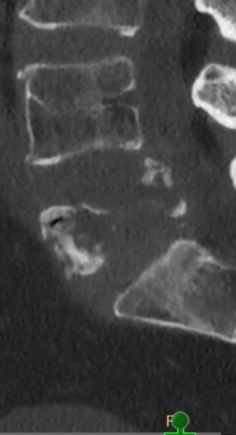 ChakravarthyMD's tweet photo. What factors influence your decision-making to involve Minimally Invasive Techniques in Spine Oncology?
❓How would you approach this #SpineOncology Case?
Details are in the thread below.
#spine #neurosurgery #MultipleMyeloma #PathologicFracture https://t.co/GjzOGr6ePI