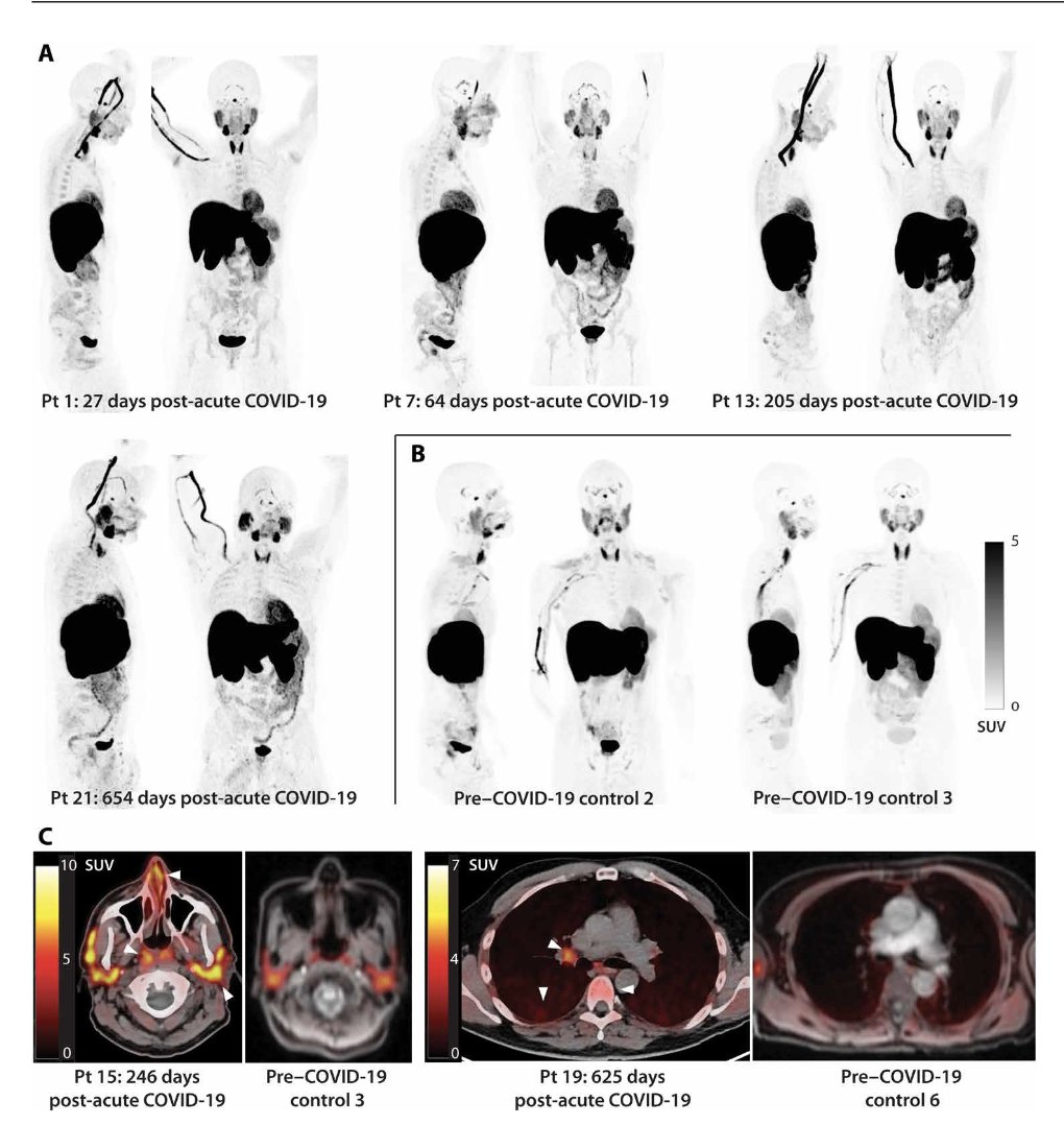 EricTopol's tweet photo. Up to 2 years after Covid, persistent virus and T cell activation in multiple tissues, especially high in gut #LongCovid
https://t.co/l07vFVdxoW @ScienceTM @MichaelPelusoMD and colleagues @UCSF @UCSFMedicine https://t.co/giuOSYc6y7