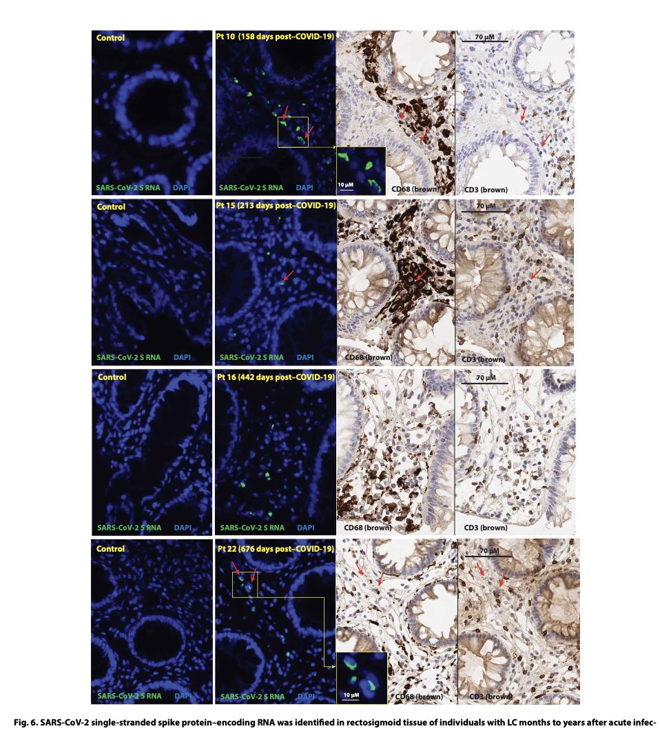 EricTopol's tweet photo. Up to 2 years after Covid, persistent virus and T cell activation in multiple tissues, especially high in gut #LongCovid
https://t.co/l07vFVdxoW @ScienceTM @MichaelPelusoMD and colleagues @UCSF @UCSFMedicine https://t.co/giuOSYc6y7