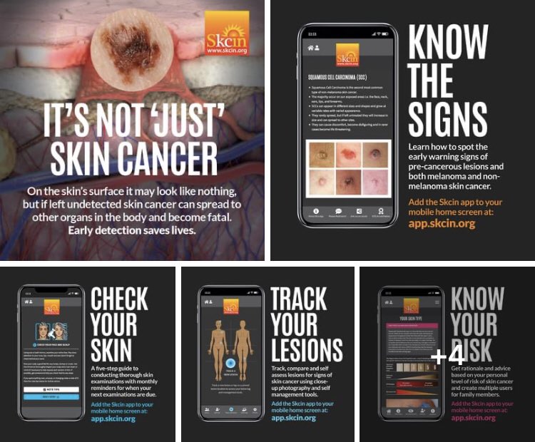SKIN CANCER IS THE WORLD’S MOST COMMON CANCER!Check your skin monthly. Get to know every lump, mole, freckle &amp; mark. Keep an eye out for anything new, unusual or skin lesion that’s changing in size,shape,colour, surface characteristics or sensation. If in doubt get it checked out