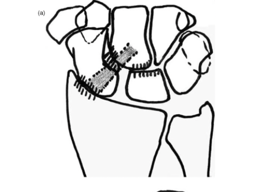 🧵 Scapholunate (SL) ligament injury is the most common ligament injury in the wrist

Here are 9⃣ things you should know...
#Handtwitter #plasticsurgery #orthotwitter