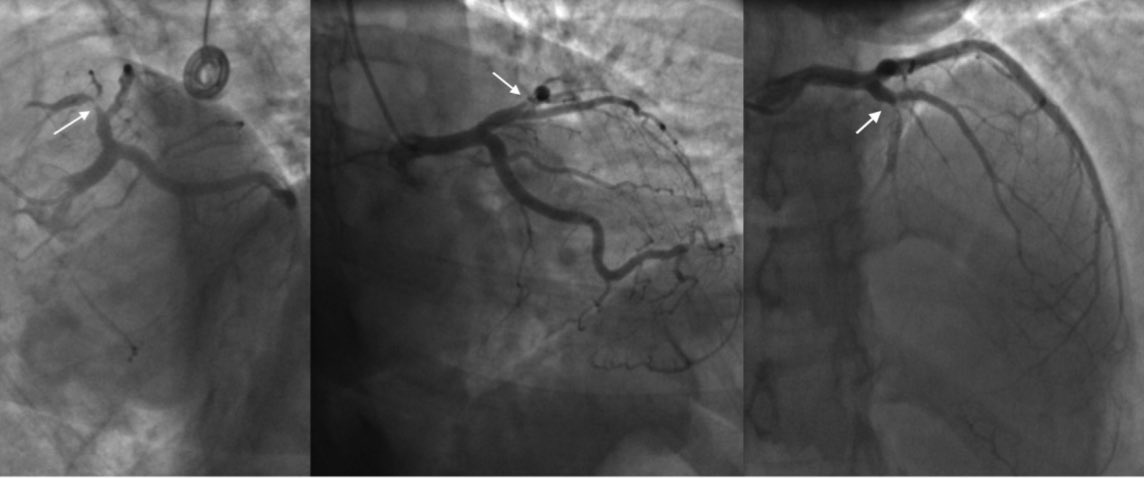 Shiavax J. Rao (@shiavaxjraomd) on Twitter photo Check out our recently published case series and literature review on #SCAD 🫀#CardioTwitter #CardioEd #MedEd #MedTwitter <a href="/MHIM_Baltimore/">MedStar Health Internal Medicine Residency Program</a> <a href="/MedStarResearch/">MedStar Health Research</a> <a href="/MedStarAcademic/">MedStar Health Academics</a> <a href="/MedStarUMH/">MedStar Union Meml</a> 🔗 doi.org/10.55729/2000-… Check out our recently published case series and literature review on #SCAD 🫀#CardioTwitter #CardioEd #MedEd #MedTwitter <a href="/MHIM_Baltimore/">MedStar Health Internal Medicine Residency Program</a> <a href="/MedStarResearch/">MedStar Health Research</a> <a href="/MedStarAcademic/">MedStar Health Academics</a> <a href="/MedStarUMH/">MedStar Union Meml</a> 🔗 doi.org/10.55729/2000-…