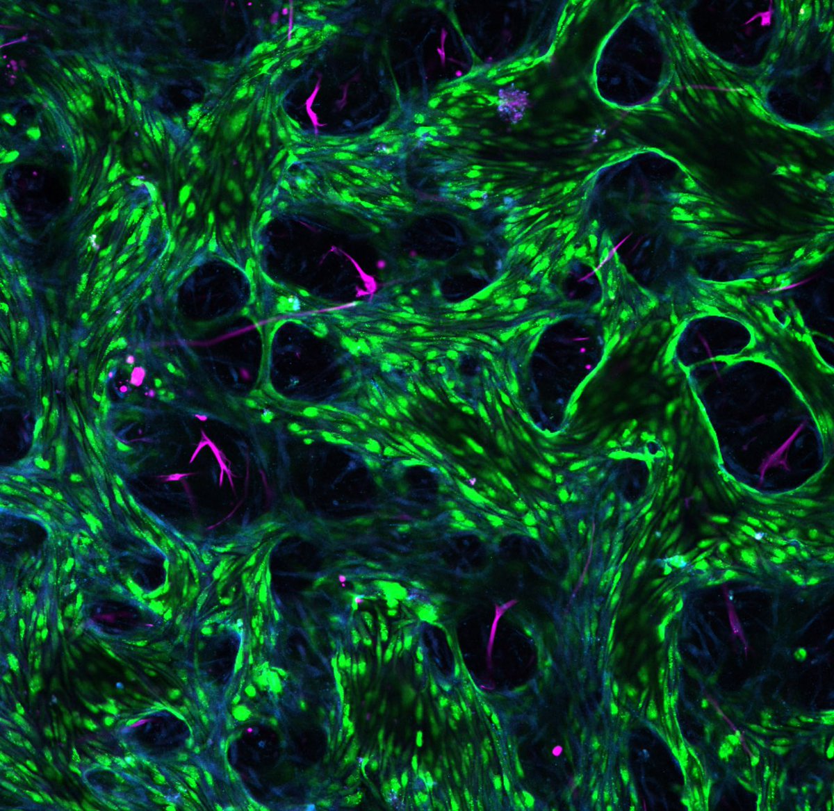 XunWangPhD's tweet photo. We’re so excited to be selected for funding by @NCIsysbio! We’ll use our 3D in-vitro human brain model @kamm_lab @MIT to explore colorectal cancer’s invasion into the brain with the Hanlee Ji Lab @Stanford! #CancerResearch #BrainModel #BrainResearch https://t.co/WzIsyhPGXi