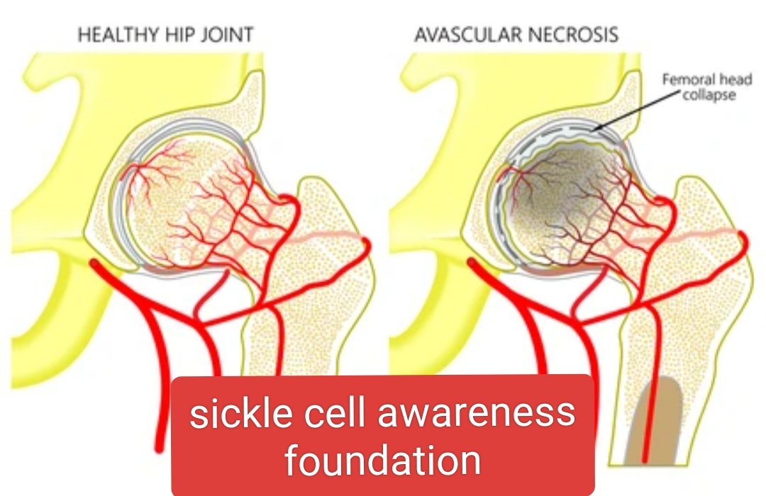 Dr Dexter(CEO-SickleCellAwarenessFoundation) (@drdexpatelscaf) on Twitter photo #sicklecelldiary
#AVN WITH SICKLE CELL DISEASE..MANY SCD PT EARLY AGE AVN is the major affect on routine life activity..<a href="/CMOGuj/">CMO Gujarat</a> <a href="/akshatdoctor/">Akshat Jain MD MPH FRCP</a> <a href="/TribalAffairsIn/">Ministry of Tribal Affairs, Govt. of India</a> <a href="/icmr_nie/">ICMR - National Institute of Epidemiology</a> <a href="/BonthaBabu_ICMR/">Bontha_Babu_ICMR</a> #sicklecelldiary
#AVN WITH SICKLE CELL DISEASE..MANY SCD PT EARLY AGE AVN is the major affect on routine life activity..<a href="/CMOGuj/">CMO Gujarat</a> <a href="/akshatdoctor/">Akshat Jain MD MPH FRCP</a> <a href="/TribalAffairsIn/">Ministry of Tribal Affairs, Govt. of India</a> <a href="/icmr_nie/">ICMR - National Institute of Epidemiology</a> <a href="/BonthaBabu_ICMR/">Bontha_Babu_ICMR</a>