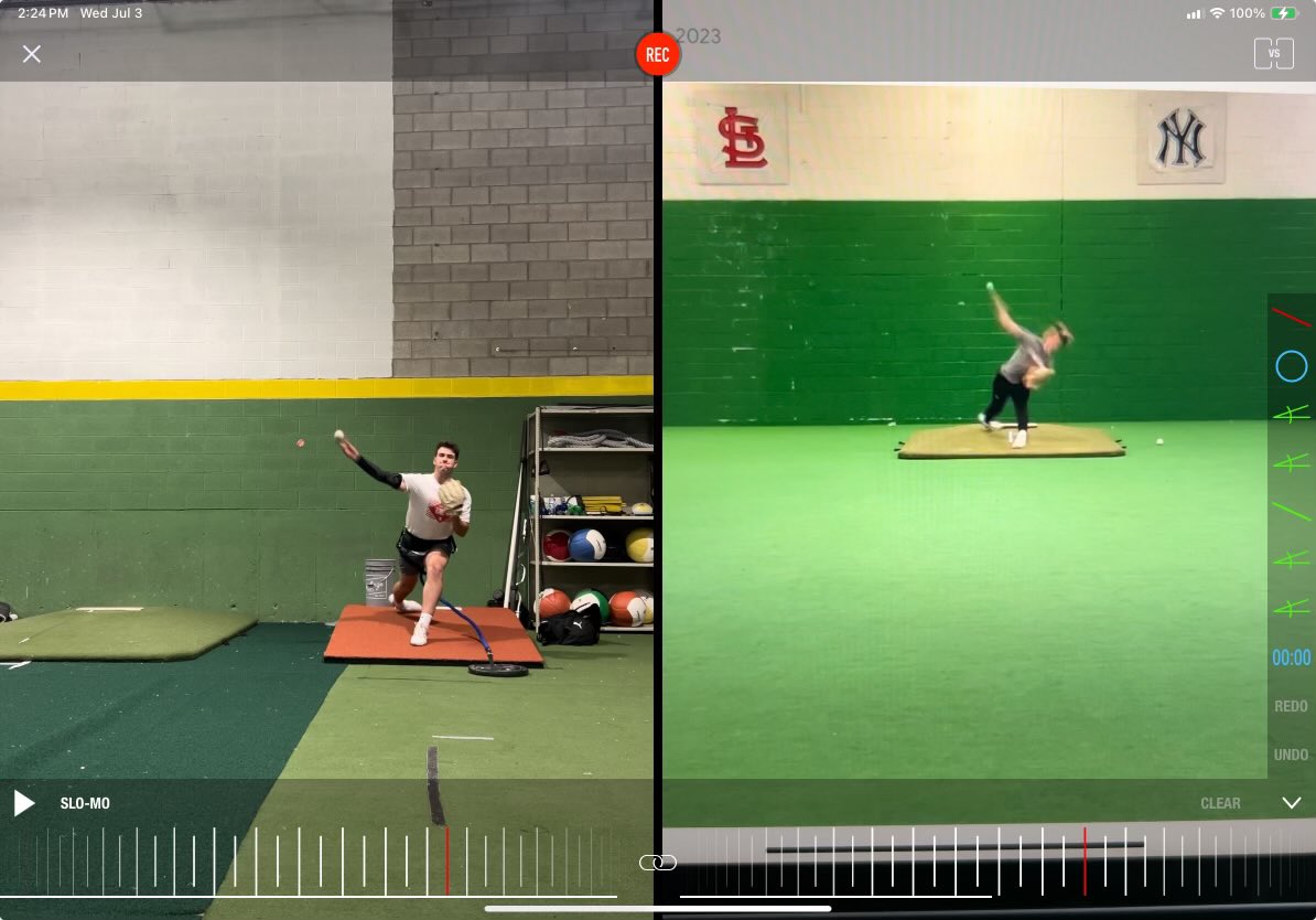 Ty Randall 10 months later.  He had a big leak with his posture falling off.  Today was just another milestone in his rehab process from TJ.