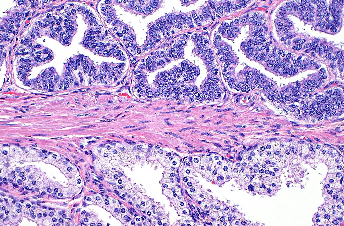 High grade PIN (top) versus normal prostate glands (bottom) ~ #GUpath