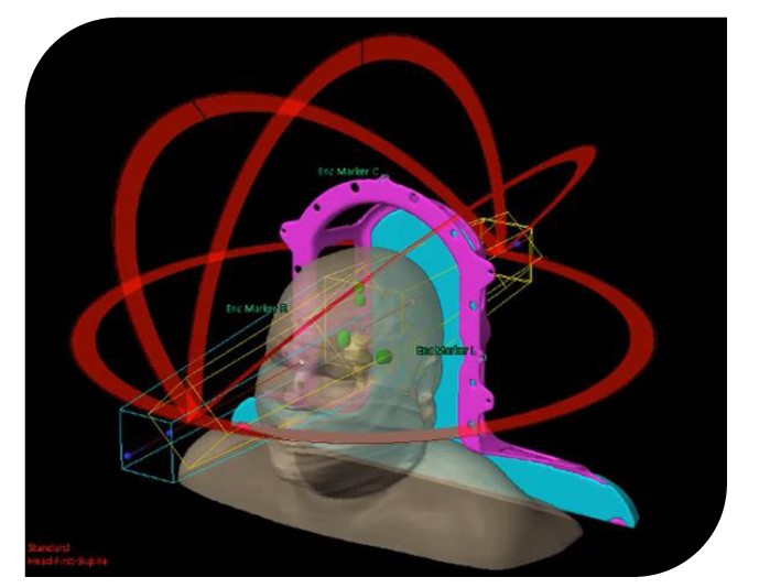 hospitaldelmar's tweet photo. El Servicio de #OncologíaRadioterápica incorpora un nuevo #software para mejorar el tratamiento de pacientes con #metástasis cerebral

Es pionero en Cataluña en su incorporación. Permite incrementar la precisión del cálculo de la dosis de #radioterapia

https://t.co/oLNvnmvJm9 https://t.co/T3sIbL6R3y