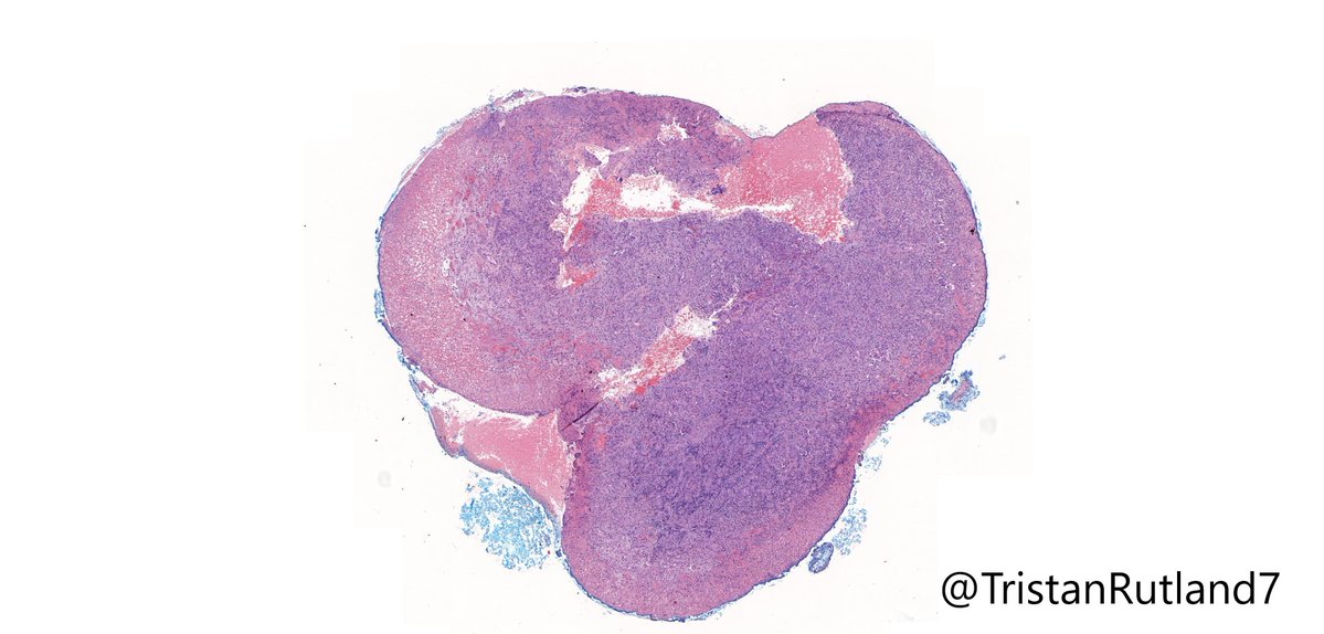 TristanRutland7's tweet photo. Oral lesion, adult

#Oralpath #ENTpath #GIpath #Pulmpath #Pathtwitter #Pathresidents https://t.co/OFiodkGBl5