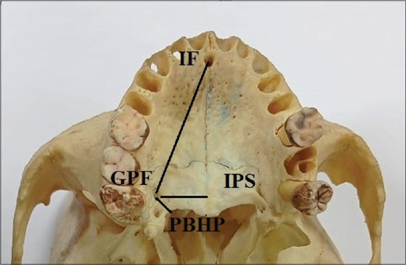 njca_info's tweet photo. Locating greater palatine foramen #GPF during operative procedures such as palatal reconstruction in #cleftPalate, #maxillary surgeries, and #intraoral maxillary nerve block is important.
Explore more about #GPF
https://t.co/qyDlR8Nepv
#NJCA
#MedTwitter
#GPF
#DentalCare https://t.co/ZED8VdSVOJ