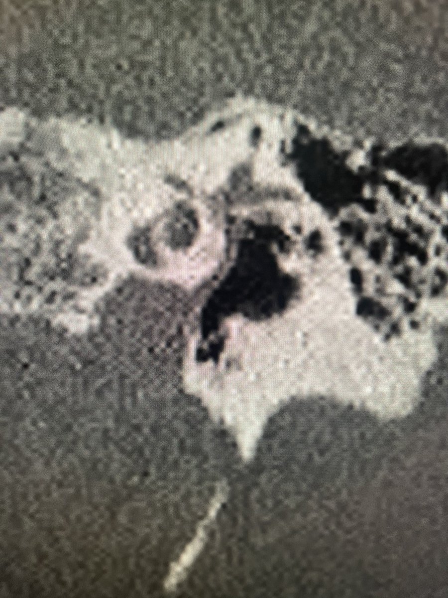 Dr Steve Colley (@entradiology) on Twitter photo Fresh from the excellent #BSHNI annual meeting, this persistent stapedial artery crops up on my first reporting / trainee checking session back at work. Must be the <a href="/amyfjuliano/">Amy Juliano</a> effect…👍👍
<a href="/BshniTrainees/">BSHNI Trainees</a> <a href="/BSHNI_UK/">British Society of Head & Neck Imaging</a> <a href="/ESHNRSociety/">ESHNR</a> <a href="/ASHNRSociety/">ASHNR</a> <a href="/thecortexclub/">The Cortex Club</a> Fresh from the excellent #BSHNI annual meeting, this persistent stapedial artery crops up on my first reporting / trainee checking session back at work. Must be the <a href="/amyfjuliano/">Amy Juliano</a> effect…👍👍
<a href="/BshniTrainees/">BSHNI Trainees</a> <a href="/BSHNI_UK/">British Society of Head & Neck Imaging</a> <a href="/ESHNRSociety/">ESHNR</a> <a href="/ASHNRSociety/">ASHNR</a> <a href="/thecortexclub/">The Cortex Club</a>