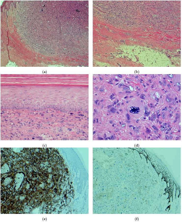 Dermatopathology (@der_mdpi) on Twitter photo 📢New Publication: Histopathologic Evaluation of Atypical Fibroxanthoma or Pleomorphic Dermal Sarcoma Debulk Specimen from Mohs Surgery: A Requirement for Their Proper Distinction #dermpath
from Dr. Muhammad N. Mahmood <a href="/DocNosh97/">M. Nausherwan Mahmood م نوشیروان محمود</a>
Access for Free: mdpi.com/2296-3529/11/3… 📢New Publication: Histopathologic Evaluation of Atypical Fibroxanthoma or Pleomorphic Dermal Sarcoma Debulk Specimen from Mohs Surgery: A Requirement for Their Proper Distinction #dermpath
from Dr. Muhammad N. Mahmood <a href="/DocNosh97/">M. Nausherwan Mahmood م نوشیروان محمود</a>
Access for Free: mdpi.com/2296-3529/11/3…