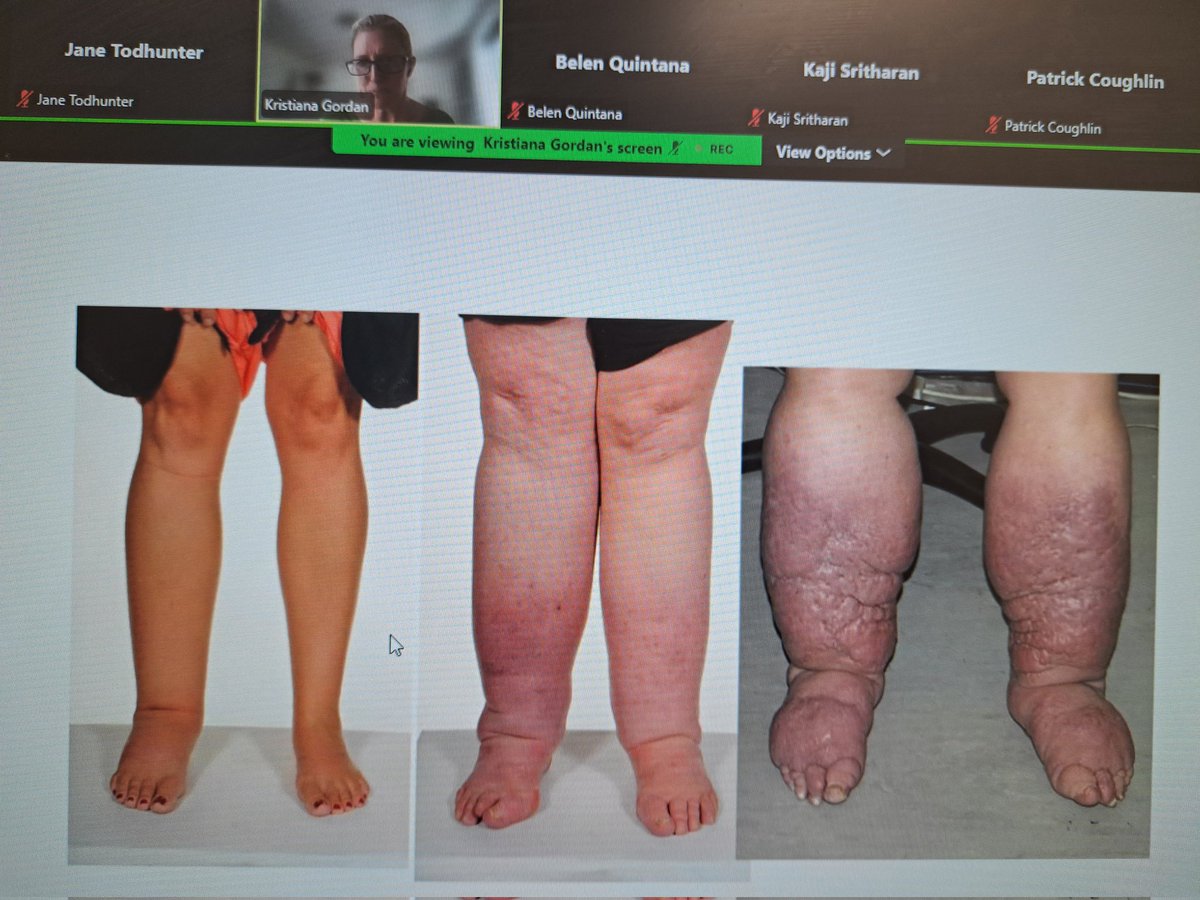 Jane Todhunter (@todhunterj50297) on Twitter photo Great session on lymphoedema in the SVN & VS symposium. Take home message, cellulitis with lymphoedema needs extended course of IV ABx <a href="/vascularnurses/">SVN (Society of Vascular Nurses)</a> <a href="/LegsMatter/">LegsMatter</a> Great session on lymphoedema in the SVN & VS symposium. Take home message, cellulitis with lymphoedema needs extended course of IV ABx <a href="/vascularnurses/">SVN (Society of Vascular Nurses)</a> <a href="/LegsMatter/">LegsMatter</a>