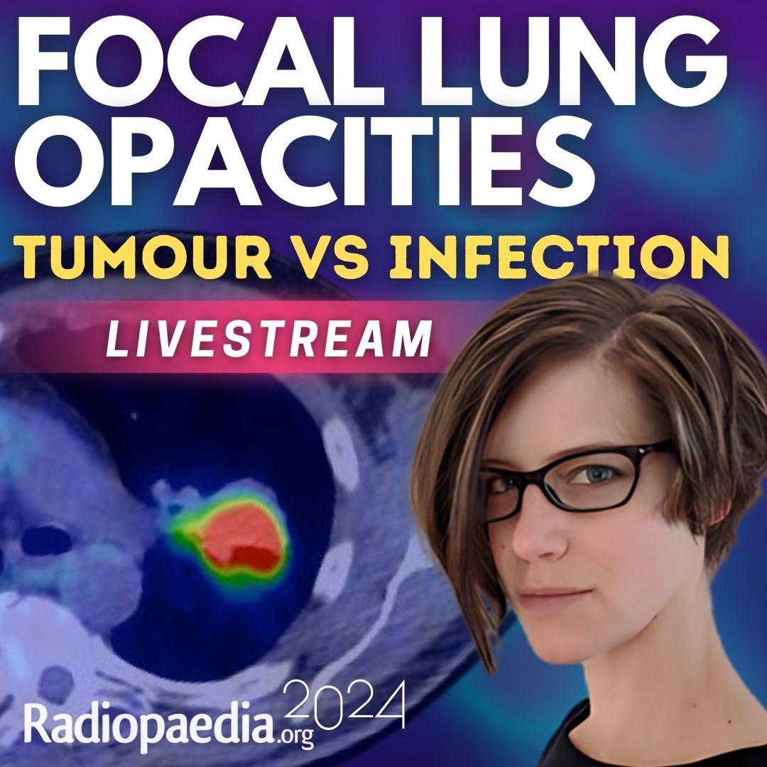 Radiopaedia.org (@radiopaedia) on Twitter photo Our next Free Friday Livestream takes place tomorrow (Friday 5 July) at 0900 UTC.
Join us over on our YouTube channel (youtube.com/radiologychannโฆ) for a stream of Dr Miranda Siemienowicz's lecture on focal lung opacities, hosted by <a href="/murf1990/">Andrew Murphy</a>.
#Radiopaedia2024 #chestrad Our next Free Friday Livestream takes place tomorrow (Friday 5 July) at 0900 UTC.
Join us over on our YouTube channel (youtube.com/radiologychannโฆ) for a stream of Dr Miranda Siemienowicz's lecture on focal lung opacities, hosted by <a href="/murf1990/">Andrew Murphy</a>.
#Radiopaedia2024 #chestrad