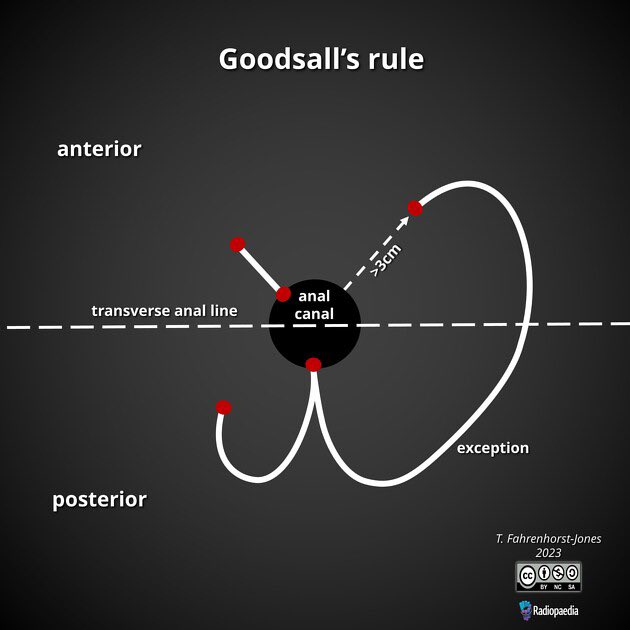 CiruAndes2's tweet photo. The Goodsall rule for anorectal fistula and its exception 👁️💥⤵️🔪⚡️💩! #SoMe4Surgery @PipeCabreraV @juliomayol @pferrada1 @SWexner @TomVargheseJr https://t.co/IDSwgijBTT