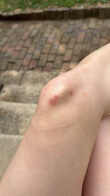 I have mat burn and I quit bjj now :( https://t.co/h37IarqYBq