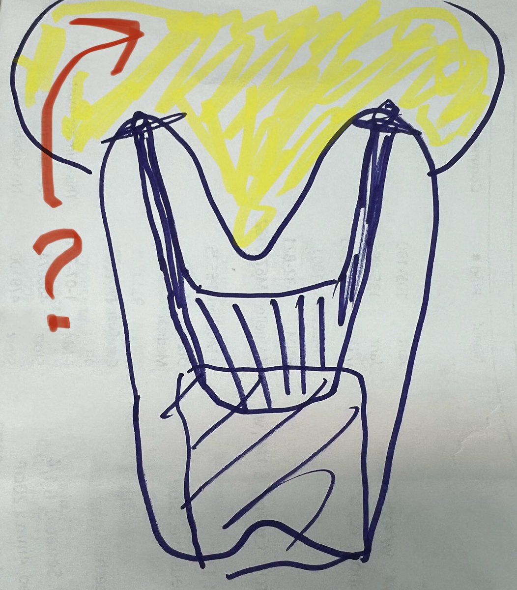 JohnCraigNose's tweet photo. Happy 4th! 🇺🇸 Apparently this is my 1000th post. Crazy. Yes I need more hobbies. Since @ent_ams and I have been delving DEEPLY into the nebulous world of dental disease and treatments for #ODS for upcoming #OCNA issue, figured I’d share a little diagram I drew in the OR, highlighting key components of a root canal treatment for a periapical abscess (PAA) (yellow). The ? is, how often does the PAA resolve, and how often does an assoc’d #ODS resolve? #ODS LAYERS coming at you in Dec 2024! @DrSujanaENT @henryfordent @MartaKwiat_ska @MakaryENT