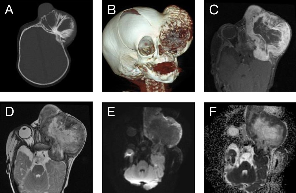 Have you seen the last <a href="/TheAJNR/">AJNR</a>  case of the week? 
shorturl.at/E6zF6

#MedEd #medicine #neurology #neurosurgery #ENT #radres #futureradres