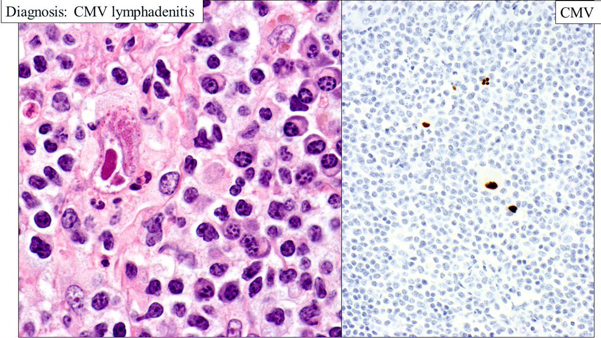 Pathologists! Check out this enlarged lymph node with a florid proliferation of monocytoid B cells, suspicious for lymphoma, but with no immuno phenotypic evidence of clonality. Turned out to be CMV lymphadenitis with many classic viral inclusions.#Hemepath #CMV