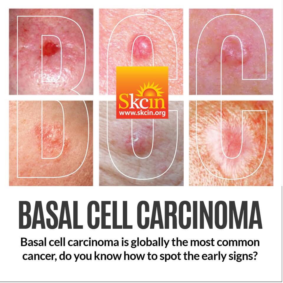 BCCs usually present on areas of skin most frequently exposed to UV radiation such as the scalp, face, ears, neck and forearms. To find out more about the early detection of all types of non-melanoma and melanoma skin cancer, install the Skcin app - app.skcin.org