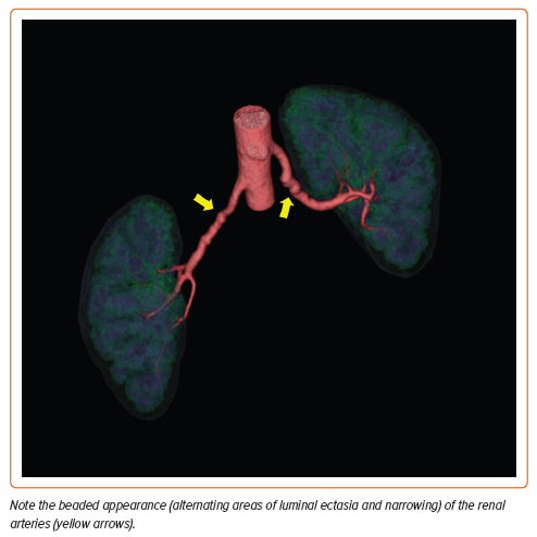 AmitGoyalMD's tweet photo. 📜@CardioNerds #USCardiology Article Alert‼️

"Sex and Gender Differences in Fibromuscular Dysplasia" by Drs. Marianne H Khoury, Sims Hershey, @RLeLeiko 

🔗https://t.co/kDVwKRPGbx

Notes... https://t.co/GvYUKlX3p3