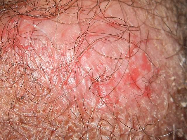 AjayChull's tweet photo. @MysteriousUchi1 @chotabulla007 @Somshekhar420 After following ur advice I'm getting burning sensation plus urine infection..my legal team @chotabulla007 will sue you if my infection increases https://t.co/QVvAC8bLqU