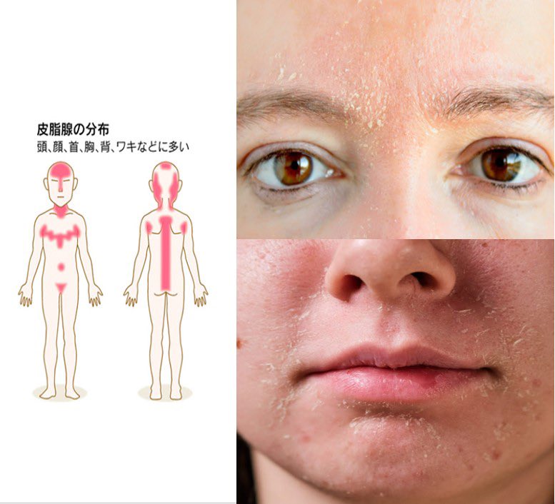 doll63966850's tweet photo. ↓みたいな赤み＋皮むけは「脂漏性皮膚炎」の可能性大。油分(乳液クリーム)は悪化するから水分保湿にしてって皮膚科で言われて色々使ったけど、ヘパトリートに変えてすぐ完治した。
乳液いらずな保湿力だし脂漏性皮膚炎に効くヘパリンとセラミド配合。ちなみに炎症性色素沈着にはラシデムが一番効いた https://t.co/RdfqpKRsdt