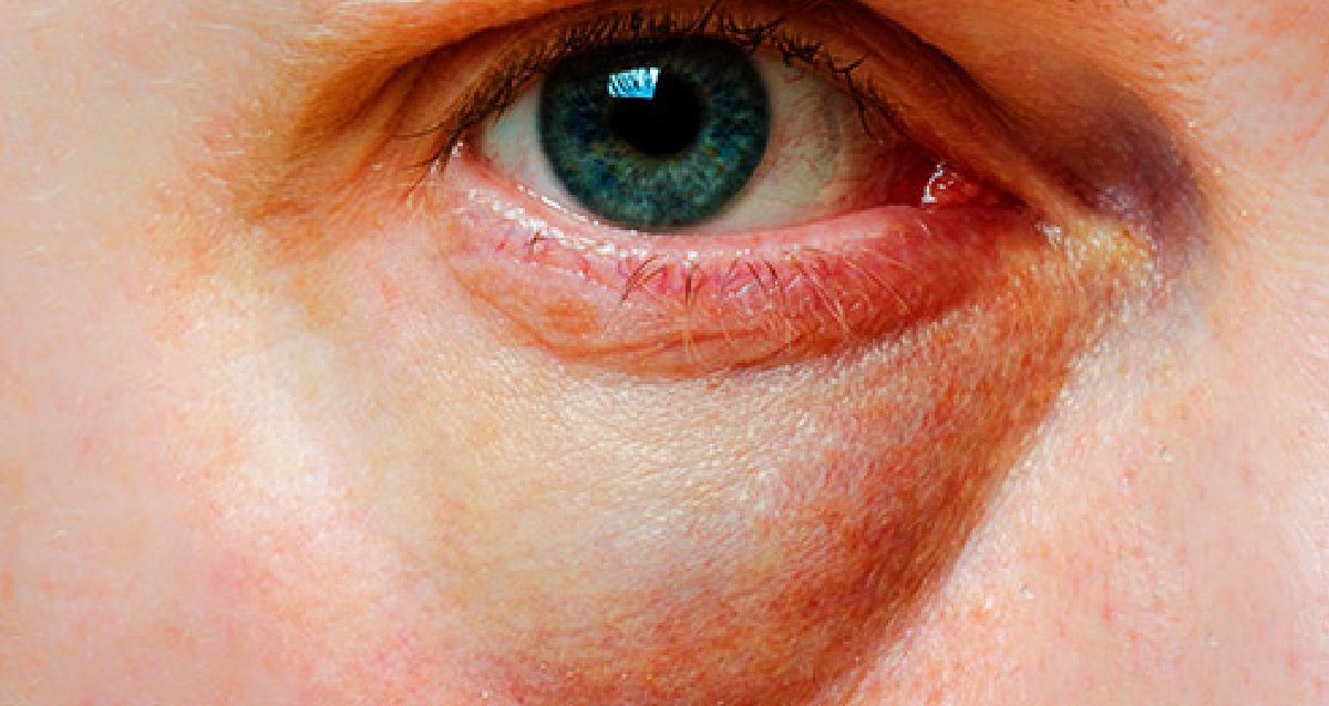 WebMD's tweet image. Want to know what causes those dark circles and bags under your eyes? Here are answers and tips for treatments, including home remedies. wb.md/4blaLom
