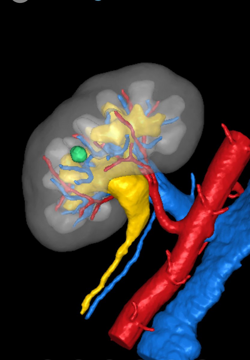 Greg Kyriazis (@greg_kyriazis) on Twitter photo 2 retroperitoneal robotic partial nephrectomies both under an hour console time. Second one was in a solitary kidney with ZERO ischaemia time. <a href="/innersightlabs/">innersightlabs</a> <a href="/MidYorkshireNHS/">Mid Yorkshire Teaching NHS Trust</a> 2 retroperitoneal robotic partial nephrectomies both under an hour console time. Second one was in a solitary kidney with ZERO ischaemia time. <a href="/innersightlabs/">innersightlabs</a> <a href="/MidYorkshireNHS/">Mid Yorkshire Teaching NHS Trust</a>