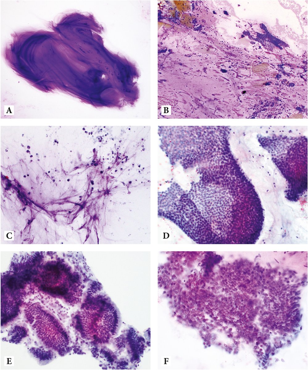 Cancer Cytopathology (@cancercytopath) on Twitter photo #FNAFriday and Free Access! Diagnostic features of low- and high-grade mucinous neoplasms in pancreatic cyst #FNA #cytology
acsjournals.onlinelibrary.wiley.com/doi/10.1002/cn…
#CytoPath <a href="/carliesigel/">cssigel</a> <a href="/WCMCPathology/">Weill Cornell Medicine Pathology</a> <a href="/Raodyisms/">Rema (Rao) Chaari</a> #FNAFriday and Free Access! Diagnostic features of low- and high-grade mucinous neoplasms in pancreatic cyst #FNA #cytology
acsjournals.onlinelibrary.wiley.com/doi/10.1002/cn…
#CytoPath <a href="/carliesigel/">cssigel</a> <a href="/WCMCPathology/">Weill Cornell Medicine Pathology</a> <a href="/Raodyisms/">Rema (Rao) Chaari</a>