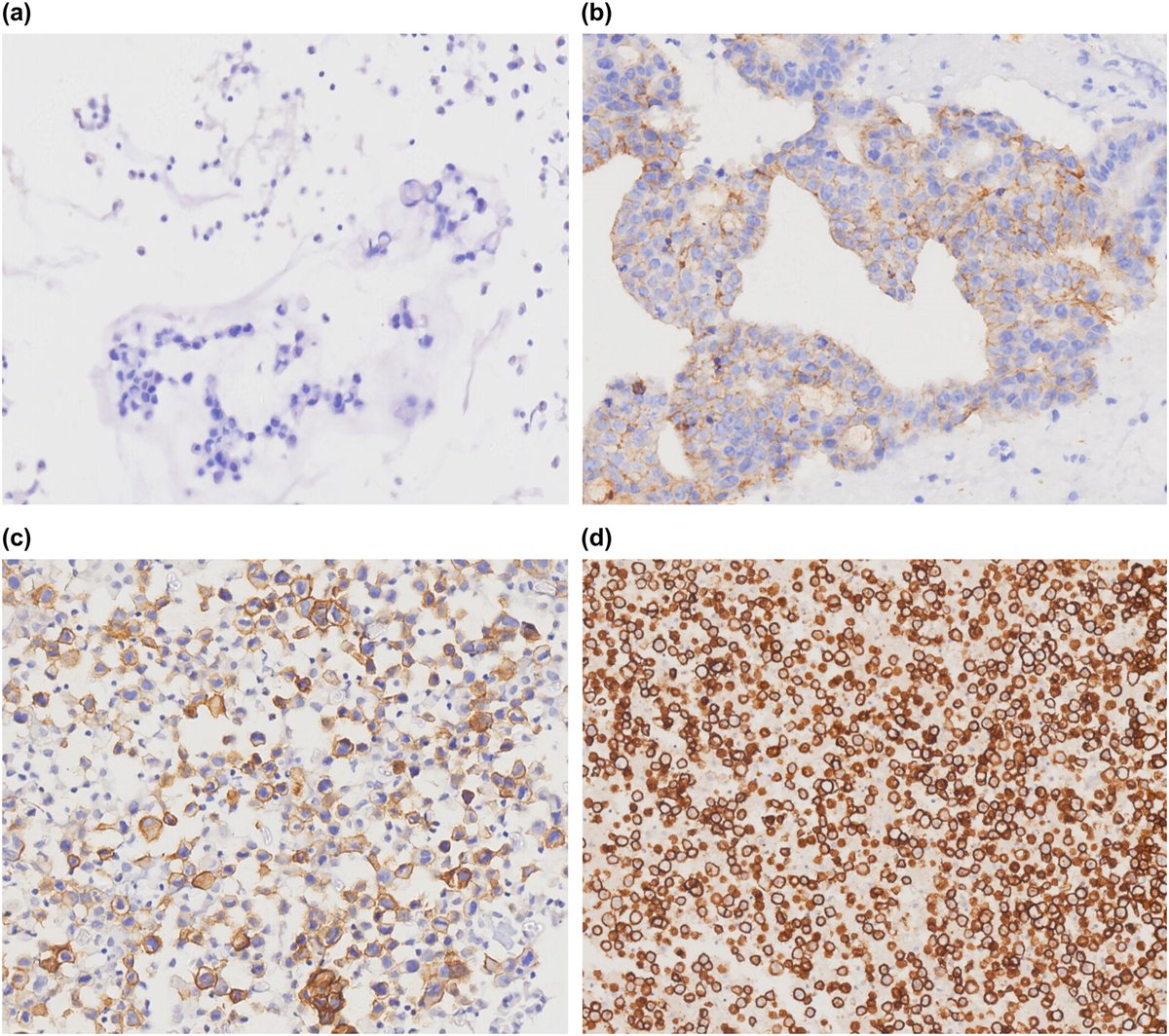 Cancer Cytopathology (@cancercytopath) on Twitter photo Free access! Claudin18.2 expression and clinicopathological features in #cytology effusion specimens from gastric adenocarcinoma: A comparative study with tissue specimens
acsjournals.onlinelibrary.wiley.com/doi/10.1002/cnā¦
#CytoPath CC: <a href="/Sinchita_Roy/">Sinchita Roy MD PhD</a> Free access! Claudin18.2 expression and clinicopathological features in #cytology effusion specimens from gastric adenocarcinoma: A comparative study with tissue specimens
acsjournals.onlinelibrary.wiley.com/doi/10.1002/cnā¦
#CytoPath CC: <a href="/Sinchita_Roy/">Sinchita Roy MD PhD</a>