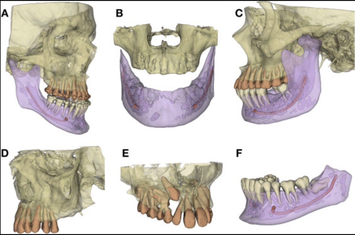 Now, you can try our validated oral and maxillofacial segmentation extension on <a href="/3DSlicerApp/">3D Slicer</a>  !

doi.org/10.1016/j.jden…

<a href="/PUMS_tweets/">Poznan University of Medical Sciences</a> @ELS_Dentistry 
#AI #Dentistry #Segemenation